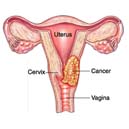 Are you aware of Cervical Cancer?
