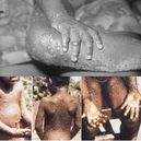 Monkeypox… Is this the next world pandemic? 